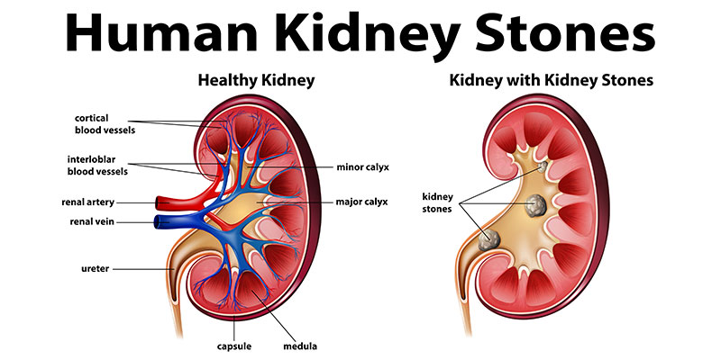 Chronic Kidney Disease