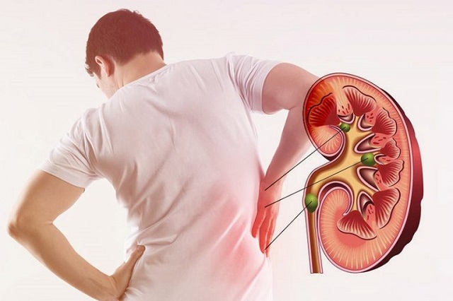 भारत में किडनी स्टोन और Chronic Kidney Disease की समस्या तेजी से बढ़ी, ये 7 सरल टिप्स अपनाकर बचाएं अपनी किडनी को स्टोन Chronic Kidney Disease