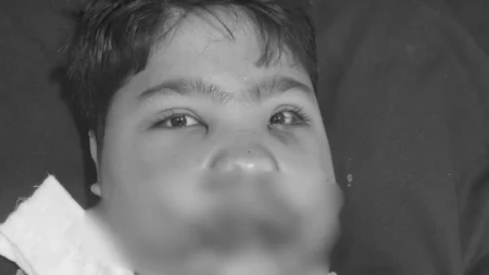 फ्रिज ब्लास्ट में घायल बच्चे के जबड़े की 5 घंटे सर्जरी कर डॉक्टरों ने दी नई ज़िंदगी, मेडिकल चमत्कार!